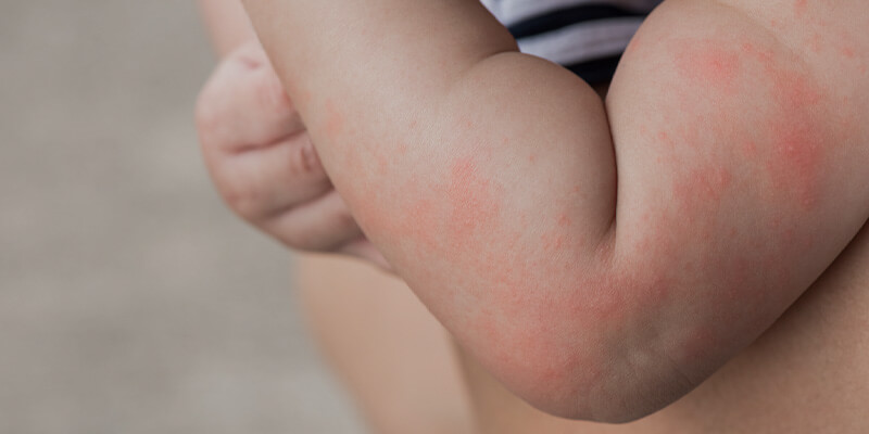 Формы и симптомы аллергии