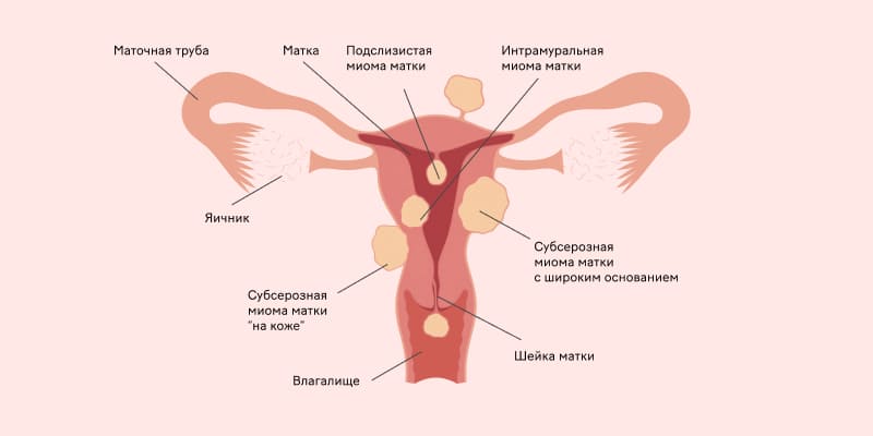 Фибромиома матки