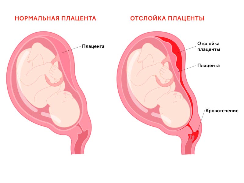 Плацентарная отслойка (отслойка плаценты)