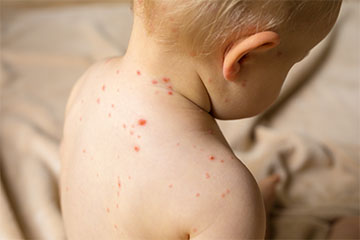 Гистаминолиберация - Пищевая аллергия - Euromed Kids